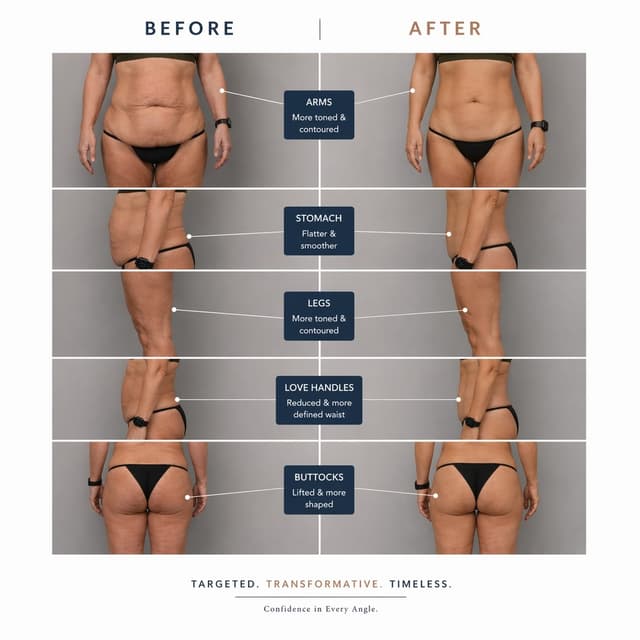 T Shape 2 Body Contouring Package at Pippins Wellness Center in Longview, TX